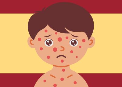 A young child with the Measles